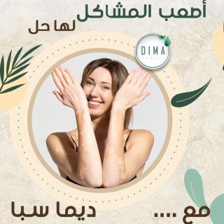 علاج البهاق | ديما سبا |  0096551189793 2