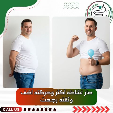 بالون المعدة مع د. فهد الإبراهيم في الكويت